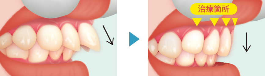 短期間できれいな歯並びを得ることができる