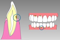 歯の根元の虫歯